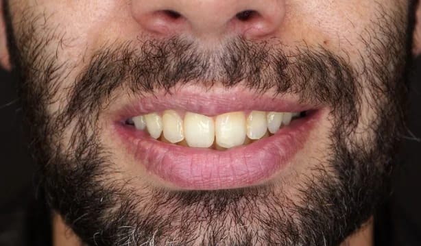Customer photo review of Teeth Whitener – For a Brighter-Looking Smile
