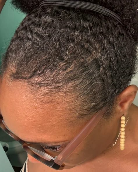 Customer photo review of AQUALYA Korean Hair Serum – Stronger-Looking Hair from the Roots