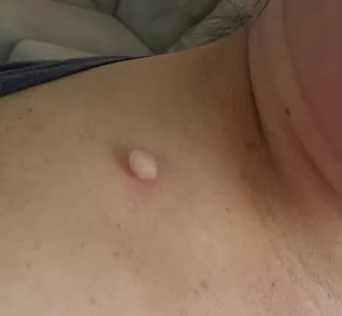 Customer photo review of Painless Skin Tag Removal Kit