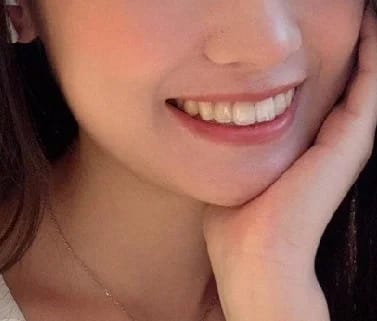 Customer photo review of Teeth Whitener – For a Brighter-Looking Smile