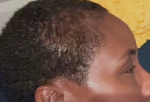 Customer photo review of Scalp Therapy System