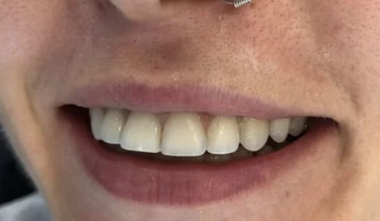 Customer photo review of Teeth Whitener – For a Brighter-Looking Smile
