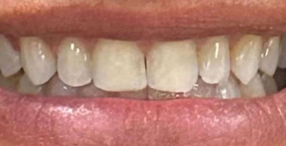 Customer photo review of Teeth Whitener – For a Brighter-Looking Smile