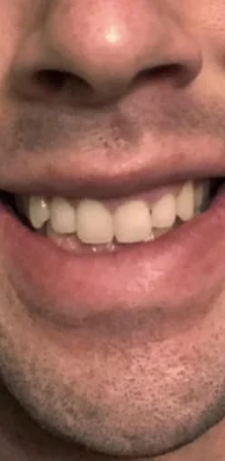 Customer photo review of Teeth Whitener – For a Brighter-Looking Smile