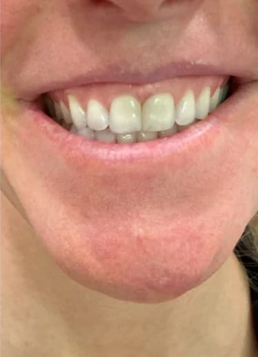 Customer photo review of Teeth Whitener – For a Brighter-Looking Smile
