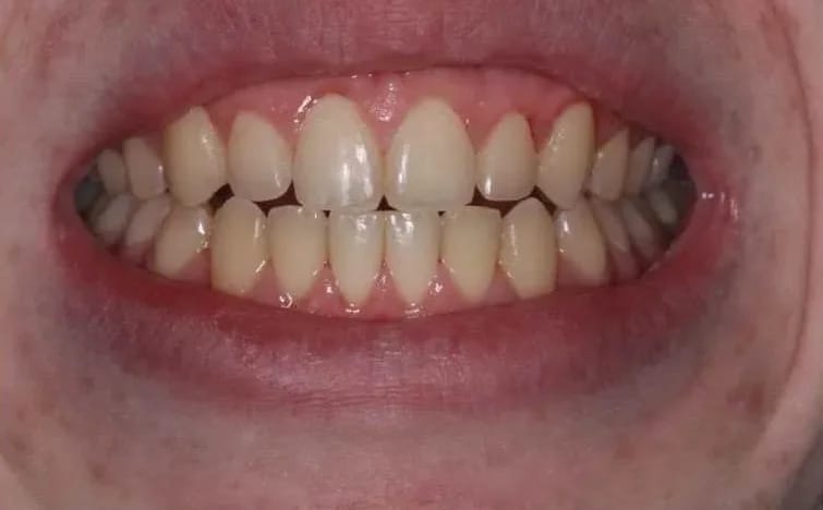 Customer photo review of Teeth Whitener – For a Brighter-Looking Smile