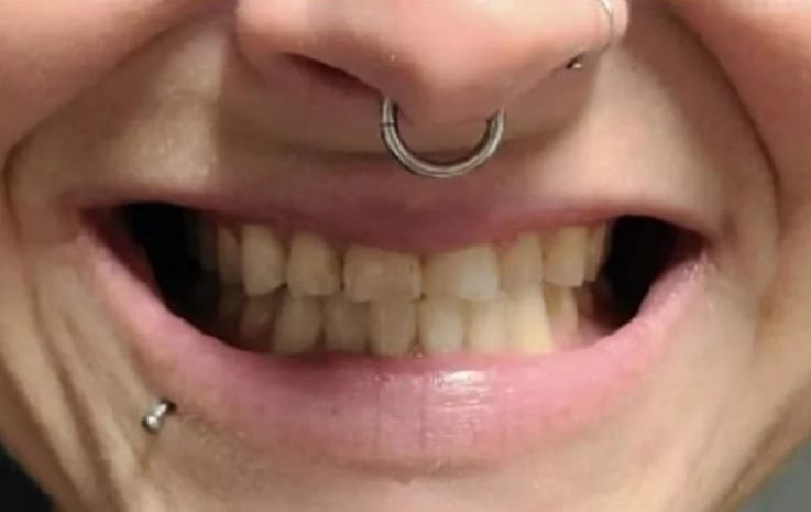 Customer photo review of Teeth Whitener – For a Brighter-Looking Smile