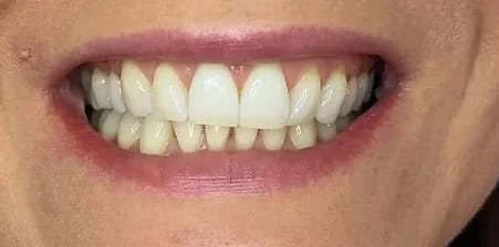 Customer photo review of Teeth Whitener – For a Brighter-Looking Smile