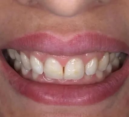 Customer photo review of Teeth Whitener – For a Brighter-Looking Smile