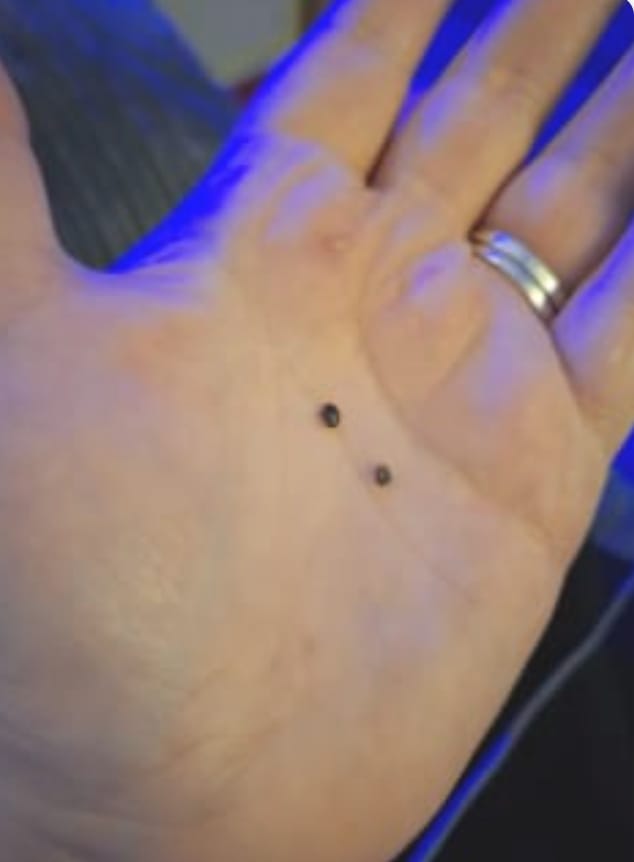 Customer photo review of Painless Skin Tag Removal Kit