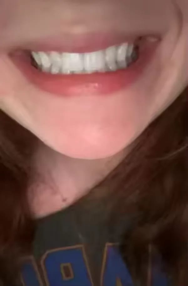 Customer photo review of Teeth Whitener – For a Brighter-Looking Smile