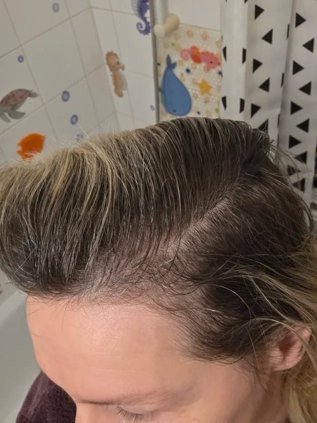 Customer photo review of AQUALYA Korean Hair Serum – Stronger-Looking Hair from the Roots