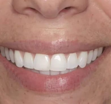 Customer photo review of Teeth Whitener – For a Brighter-Looking Smile