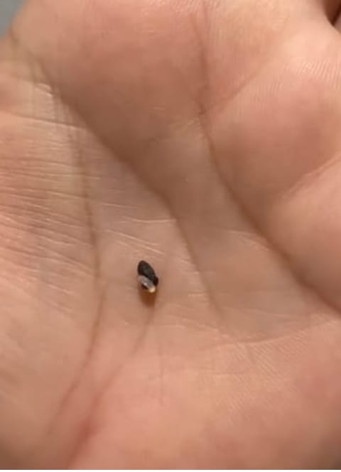 Customer photo review of Painless Skin Tag Removal Kit