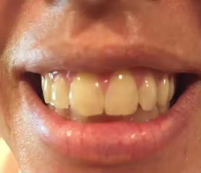 Customer photo review of Teeth Whitener – For a Brighter-Looking Smile