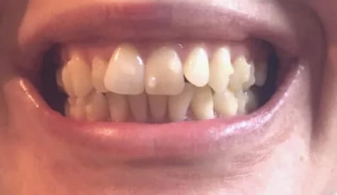 Customer photo review of Teeth Whitener – For a Brighter-Looking Smile