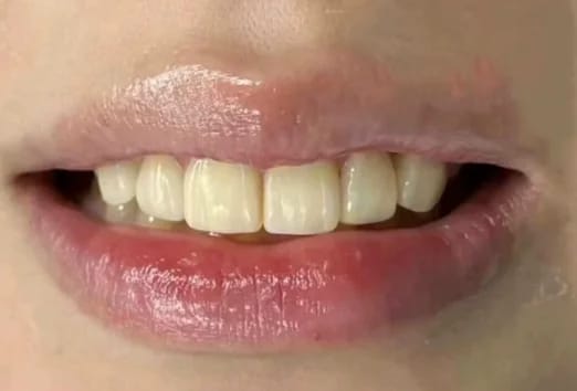 Customer photo review of Teeth Whitener – For a Brighter-Looking Smile