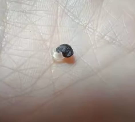 Customer photo review of Painless Skin Tag Removal Kit