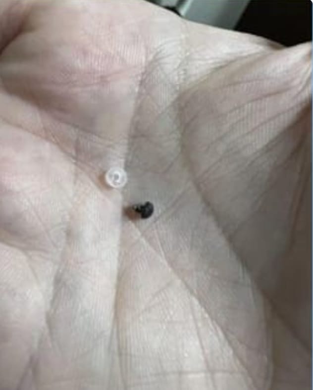 Customer photo review of Painless Skin Tag Removal Kit