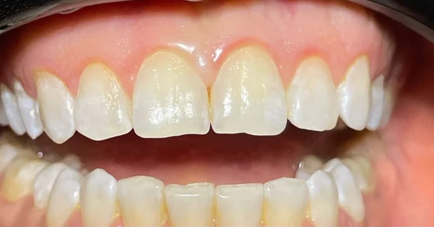 Customer photo review of Teeth Whitener – For a Brighter-Looking Smile