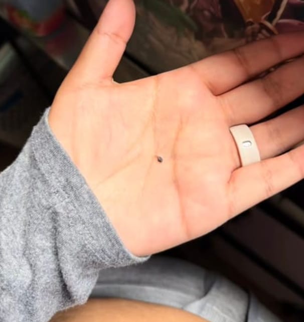 Customer photo review of Painless Skin Tag Removal Kit