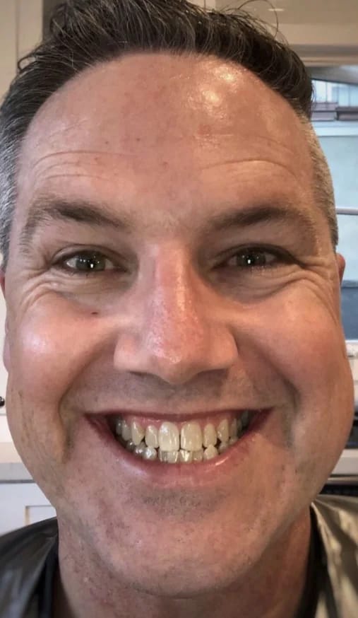 Customer photo review of Teeth Whitener – For a Brighter-Looking Smile
