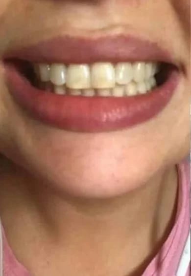 Customer photo review of Teeth Whitener – For a Brighter-Looking Smile
