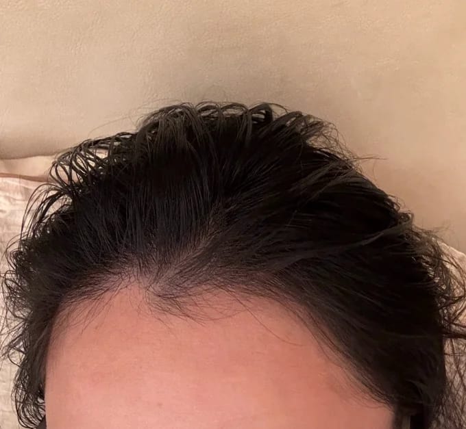 Customer photo review of AQUALYA Korean Hair Serum – Stronger-Looking Hair from the Roots