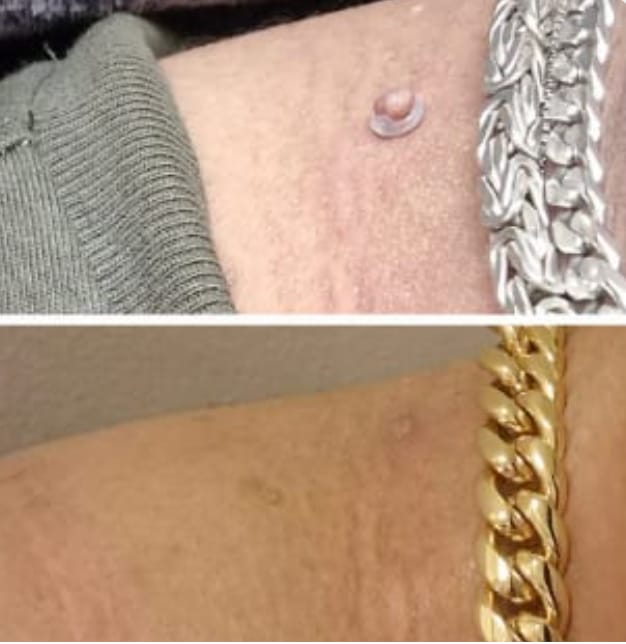 Customer photo review of Painless Skin Tag Removal Kit