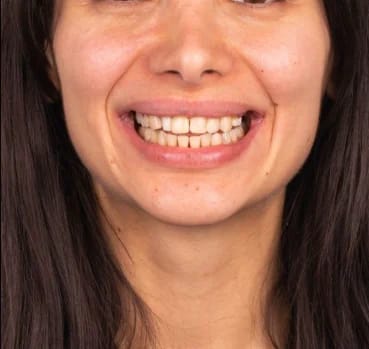 Customer photo review of Teeth Whitener – For a Brighter-Looking Smile