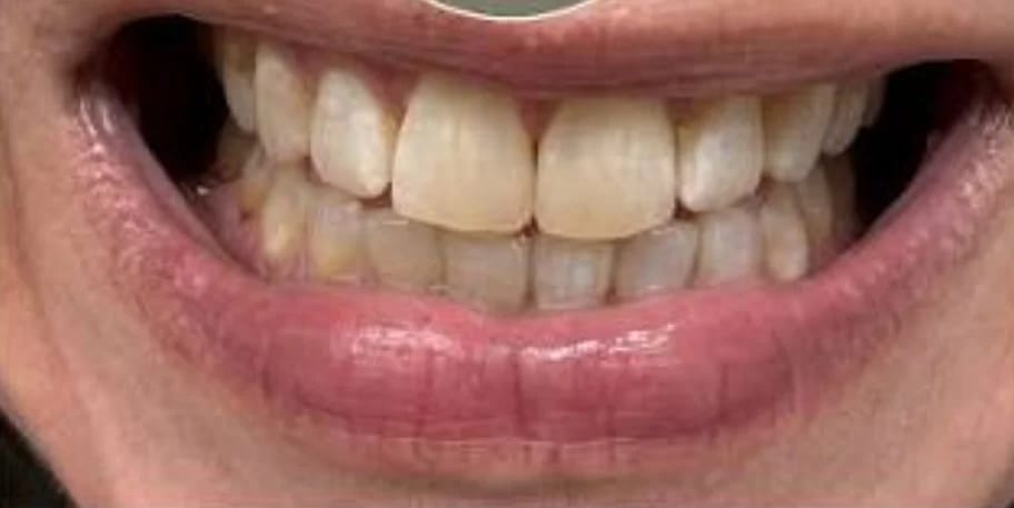 Customer photo review of Teeth Whitener – For a Brighter-Looking Smile