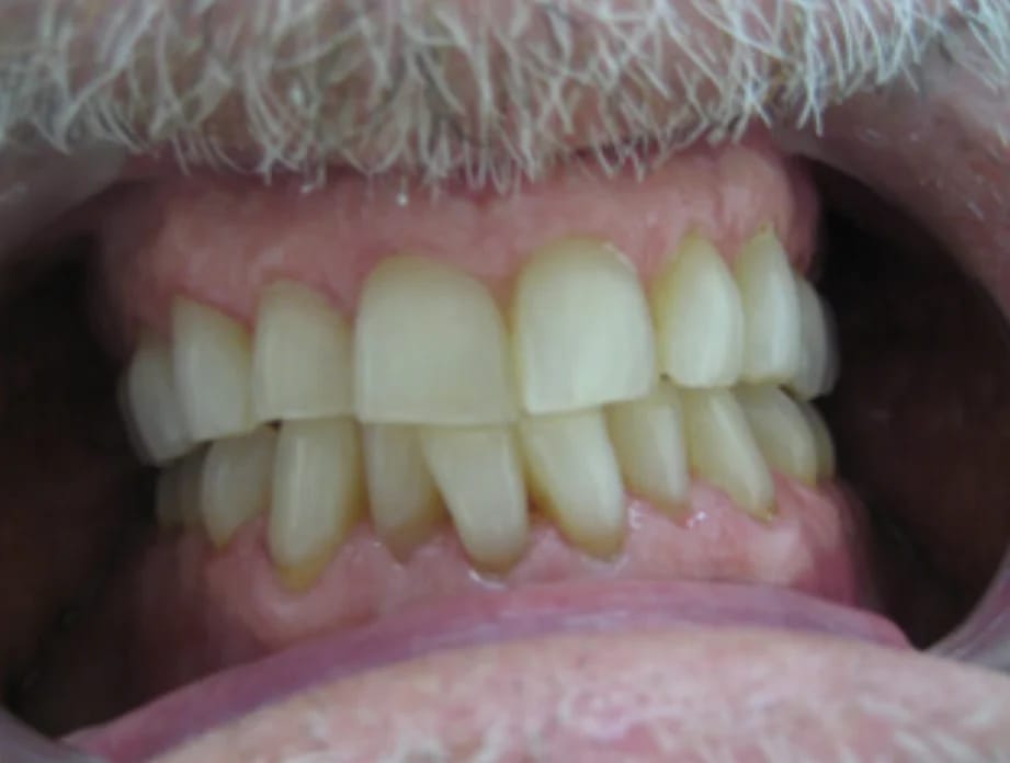 Customer photo review of Teeth Whitener – For a Brighter-Looking Smile