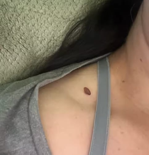 Customer photo review of Painless Skin Tag Removal Kit