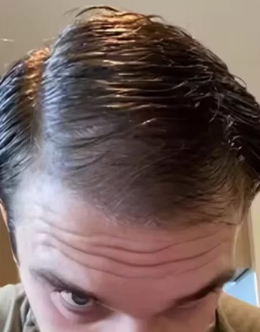 Customer photo review of AQUALYA Korean Hair Serum – Stronger-Looking Hair from the Roots