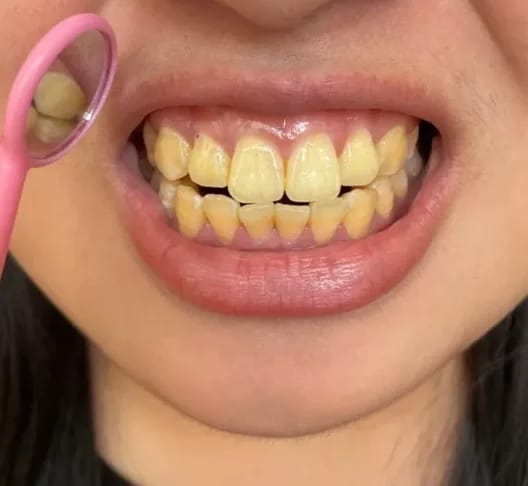 Customer photo review of Teeth Whitener – For a Brighter-Looking Smile