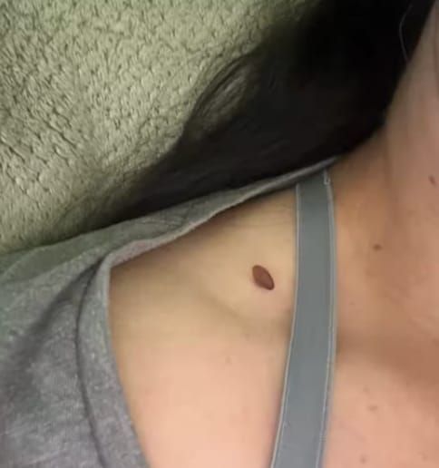 Customer photo review of Painless Skin Tag Removal Kit