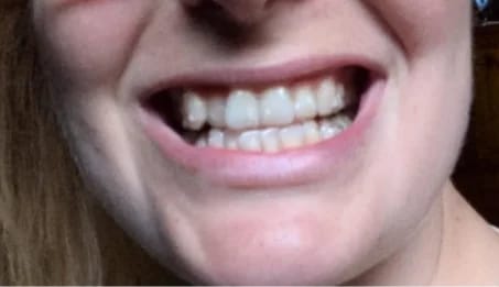 Customer photo review of Teeth Whitener – For a Brighter-Looking Smile