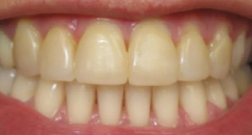 Customer photo review of Teeth Whitener – For a Brighter-Looking Smile