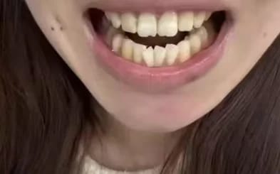 Customer photo review of Teeth Whitener – For a Brighter-Looking Smile