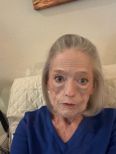 Reviewer showing their skin after four treatments with The Micro Infusion System.