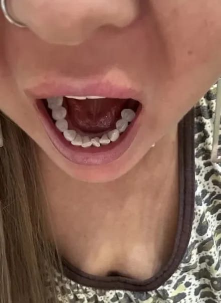 Customer photo review of Teeth Whitener – For a Brighter-Looking Smile