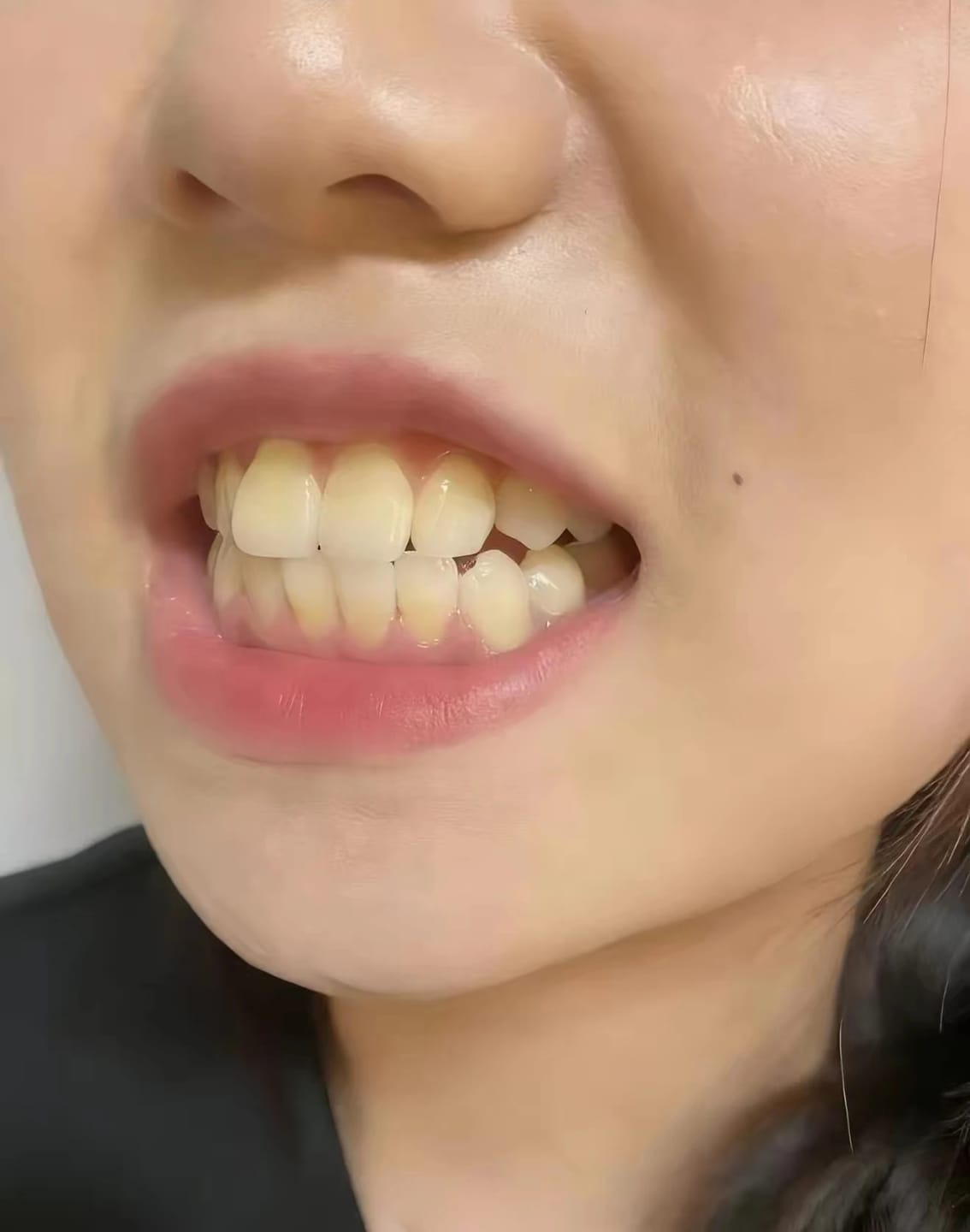 Customer photo review of Teeth Whitener – For a Brighter-Looking Smile