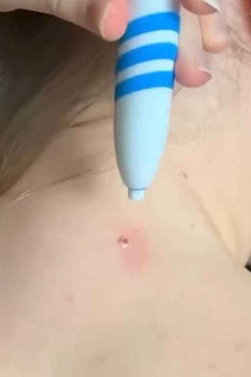 Customer photo review of Painless Skin Tag Removal Kit