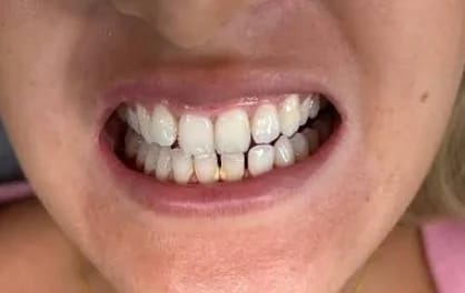 Customer photo review of Teeth Whitener – For a Brighter-Looking Smile