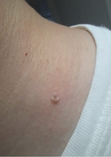 Customer photo review of Painless Skin Tag Removal Kit