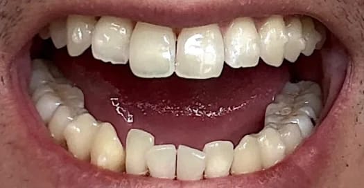 Customer photo review of Teeth Whitener – For a Brighter-Looking Smile