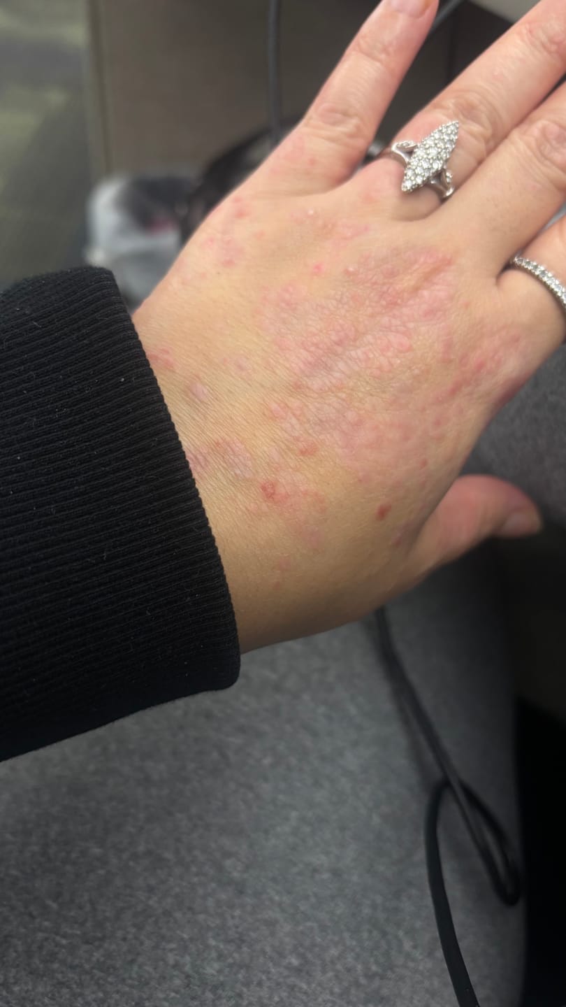 Customer photo review of Smiles & Joys Eczema and Psoriasis Herbal Cream