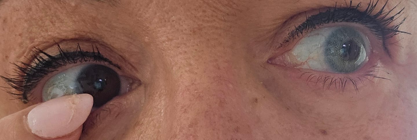 Customer photo review of Hyperopia Symphony Blue (Farsightedness Contacts)