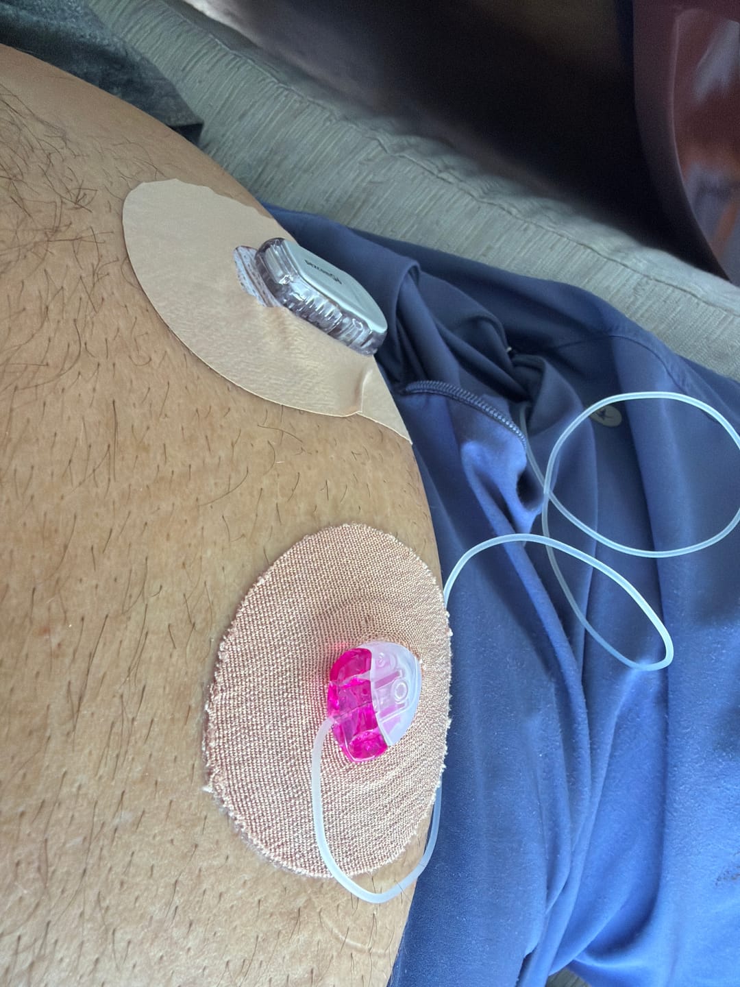 Customer photo review of Skin Grip MAX Dexcom G6 Patches - 10 Pack