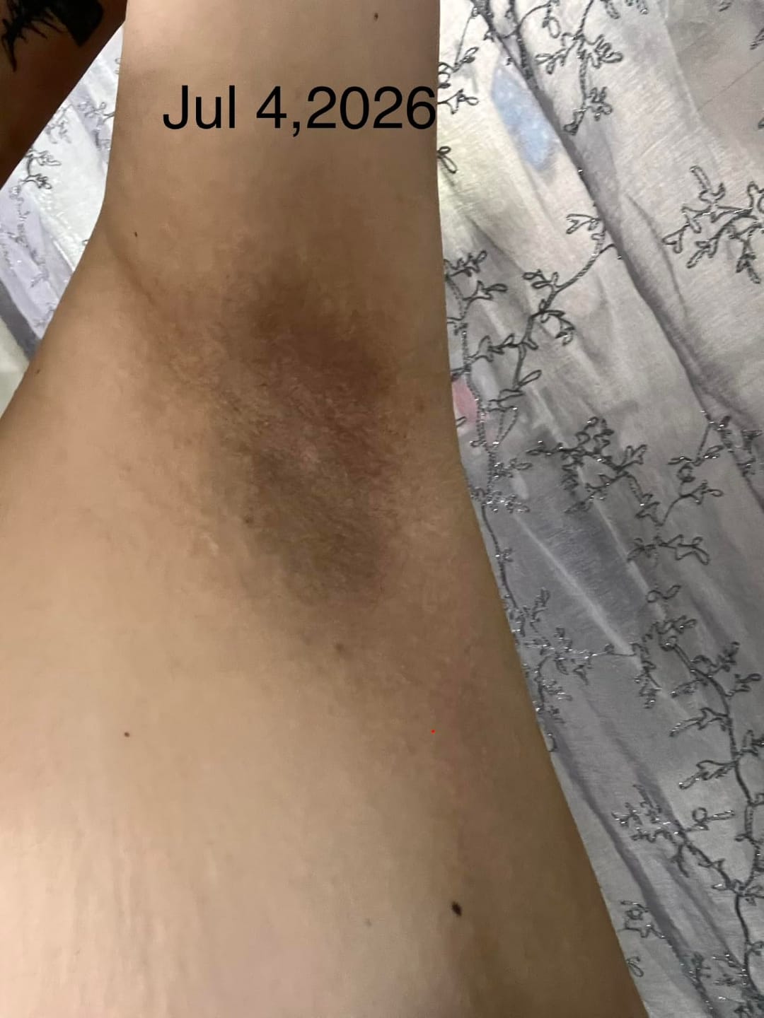 Customer photo review of Grabello Kojic Acid & Turmeric De-Tan Body Glow Spray Buy 1 Get 1 Free